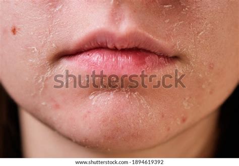 2,753 Dry Flaky Skin Images, Stock Photos & Vectors | Shutterstock