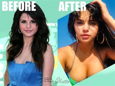 Selena Gomez Plastic Surgery Revealed! Before and After