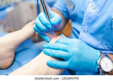 147 Laser Nail Fungus Images, Stock Photos, 3D objects, & Vectors ...