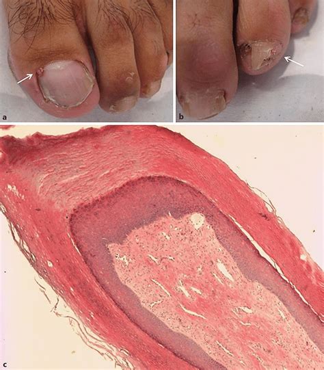 a, b Clinical photographs of ungual fibromas (arrows). c... | Download ...