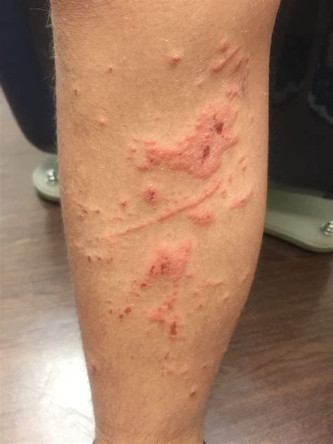 Allergic Contact Dermatitis | Pennsylvania Dermatology Specialists