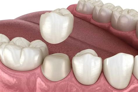 corona de porcelana clinica dental sonrisa segura