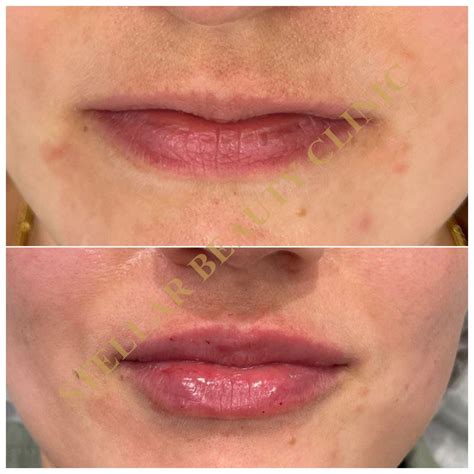 Контурная пластика - STELLAR BEAUTY CLINIC