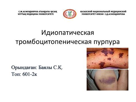 Идиопатическая тромбоцитопеническая пурпура - презентация онлайн