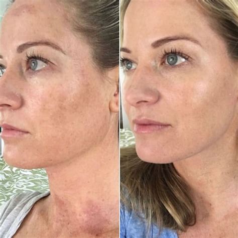 acid peel acne     eddie avila blog