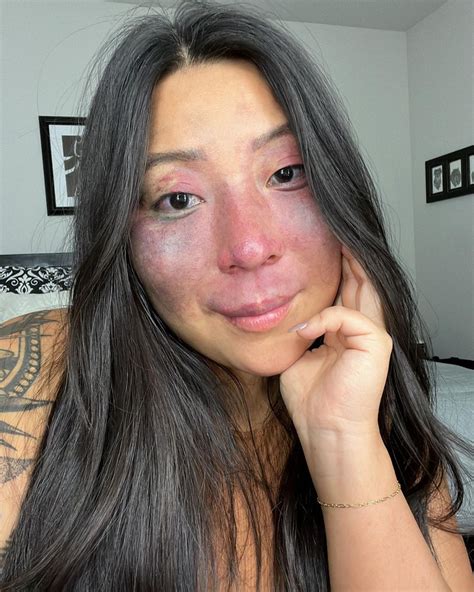 A Woman With a Face Birthmark Shares What Is Like to Always Have People ...