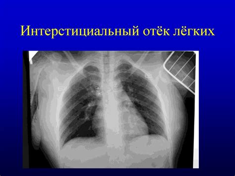 Отек легких - презентация онлайн