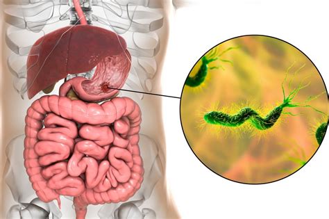 Helicobacter pylori: causes, symptoms, contagion and treatment