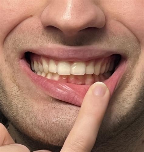 How to Mew with Overbite, Underbite, Crossbite, and Open Bite?
