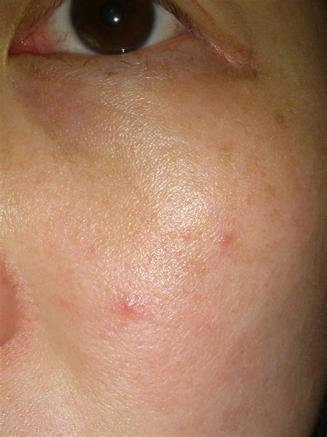 Scalp Bumps Large Bumps On Scalp Red Bumps On My Scalp Itchy Bumps