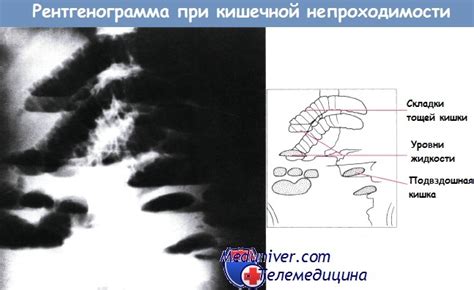 Тонкокишечная непроходимость - диагностика