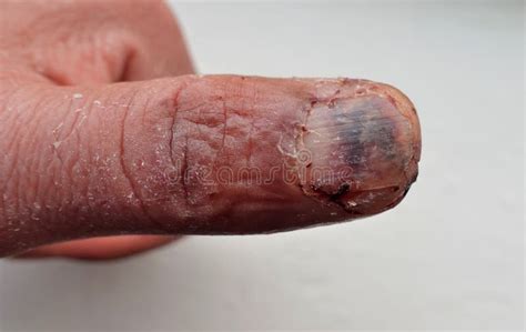 left hand thumb   injury nail damage open wound  close