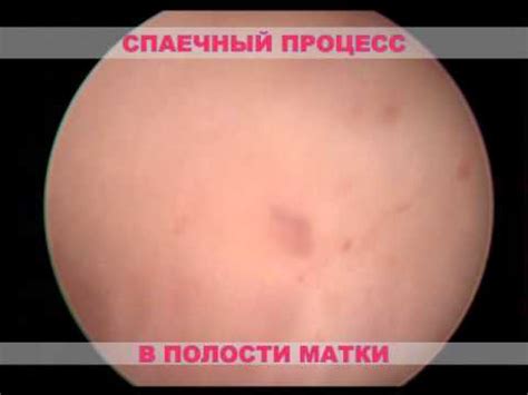 Гистероскопия - YouTube
