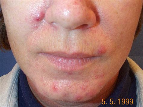 What to Expect From Retin-A Acne Treatment