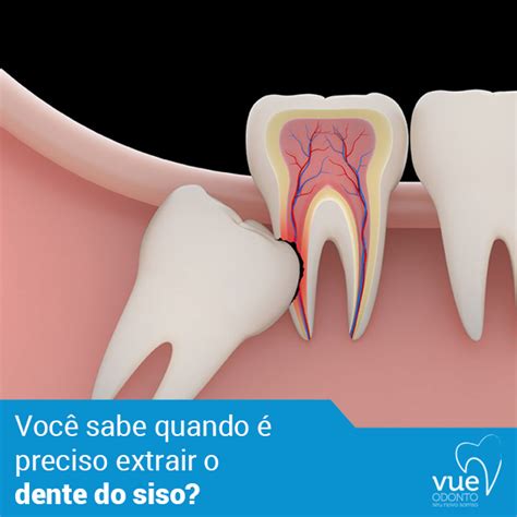 Extrai O Dente Do Siso - Você sabe quando é preciso extrair o dente do siso? A necessidade da ...