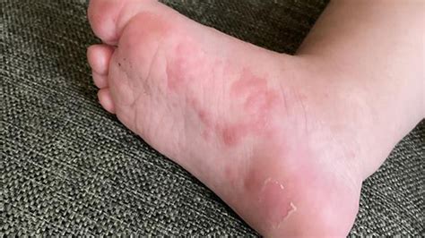 hand foot  mouth disease     rochester regional health