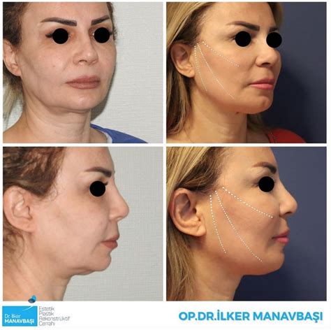 face thread lift akasya estetik