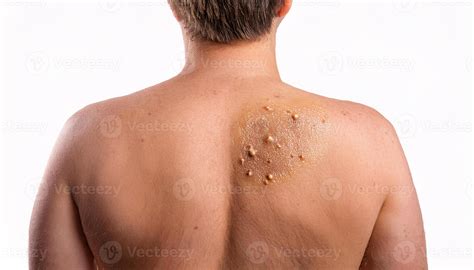 macro view of seborrheic keratosis lesions on the back with warty and
