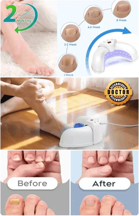 Welnax BioClear® | Official Website | Best Nail Fungus Device