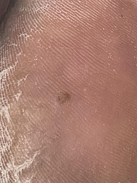 New verruca on flat of heel : r/Warts