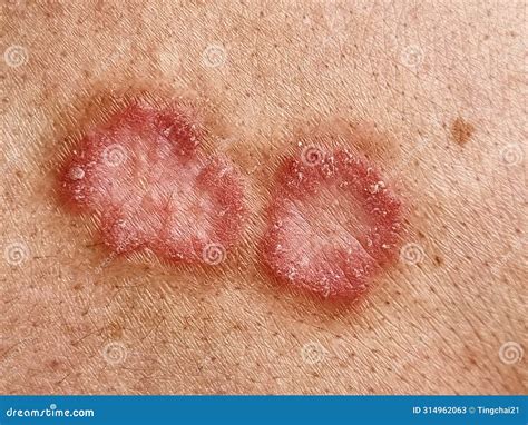 ringworm tinea corporis   human    circular shaped skin