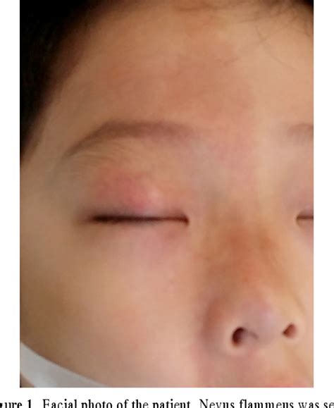 Figure 1 from A Case of Wyburn-Mason Syndrome with Facial Nevus ...