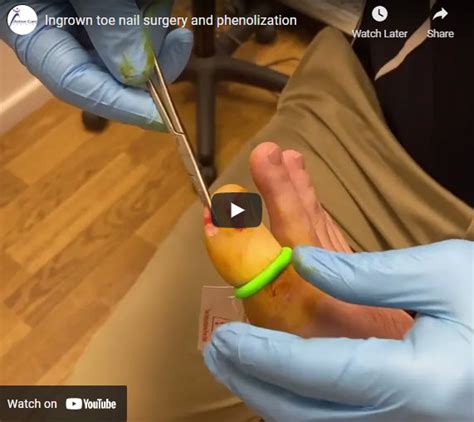 Ingrown toe nail surgery and phenolization - Active Care Podiatry