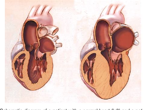 Figure 1 from Hypertrophic Cardiomyopathy A Patient Perspective ...