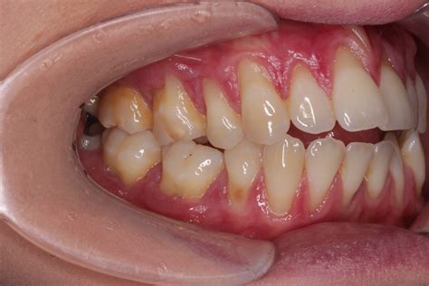 Orthodontic Update - Clear aligners for patients with severe gingival