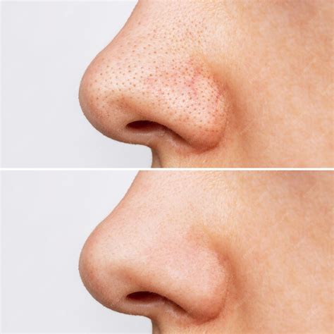 removing blackheads before and after 8