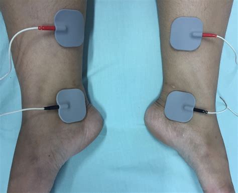 Effects of Bilateral Transcutaneous Tibial Nerve Stimulation on ...