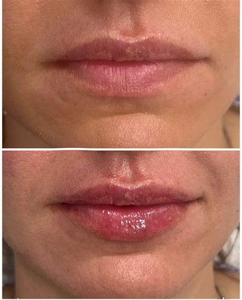Lip Filler: A Comprehensive Guide | House of Beauty