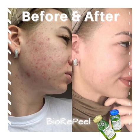 SKIN / BIOREPEEL - The "No Downtime" Peel — Primp lash & beauty ...