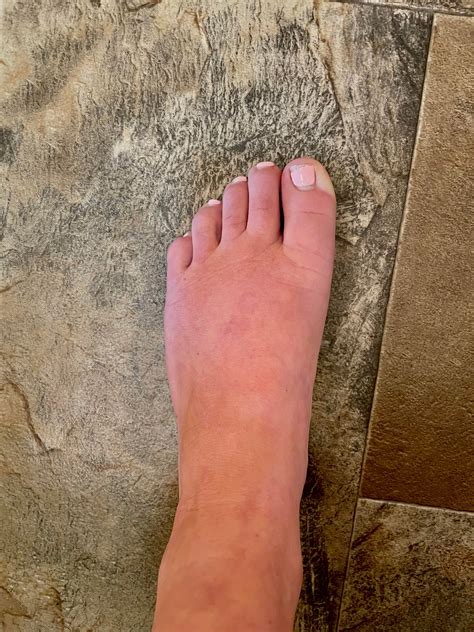 Numbness, pins and needles, pain on heels when walking, can’t warm up