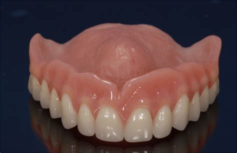 Dental Labs for Dentures in Arizona - Conventional Full and Partial ...