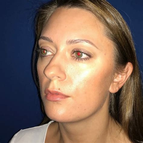 Chin-surgery-before-after-chicago (2) | Chicago Breast And Body Aesthetics