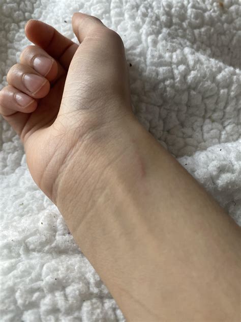Are these scabies? Doctor unsure. Prescribed antibiotics