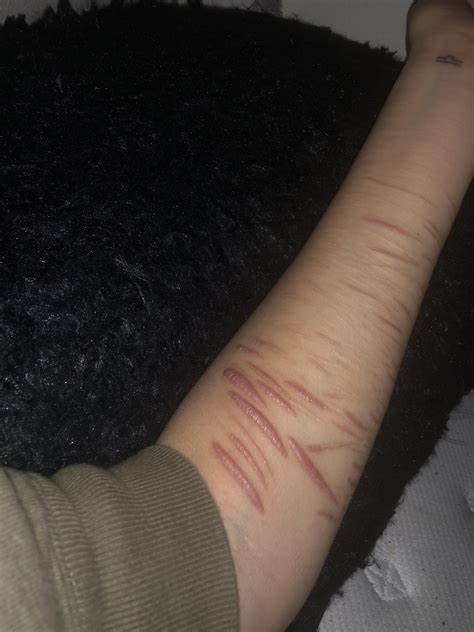 How can I hide my scars? : SelfHarmScars