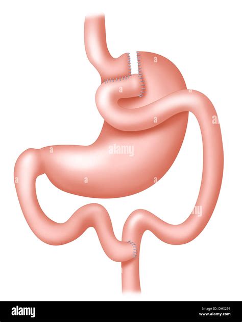 gastric bypass illustration  res stock photography  images alamy