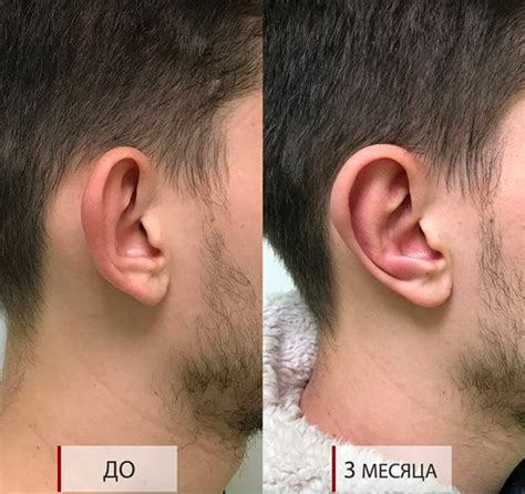 Пластика ушей - Медицинский центр «ЗДОРОВЬЕ»