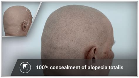 Alopecia universalis: Complete hair loss all over the body