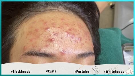 Big Cystic Acne Blackheads Extraction Blackheads & Milia, Whiteheads