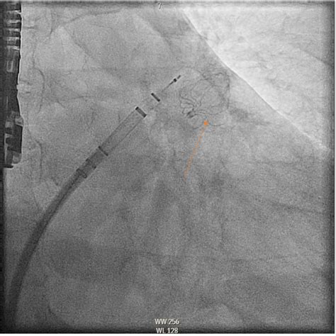 Placement of watchman device. Orange Arrow: Watchman device | Download ...