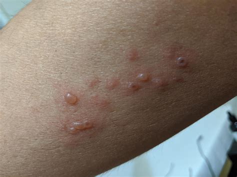 is this spider bite, should I go to Doctors...4 days old : r/spiderbites