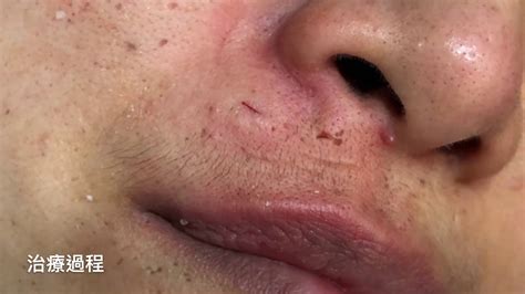 Cyst Removal On Upper Lip | Ownerlip.co