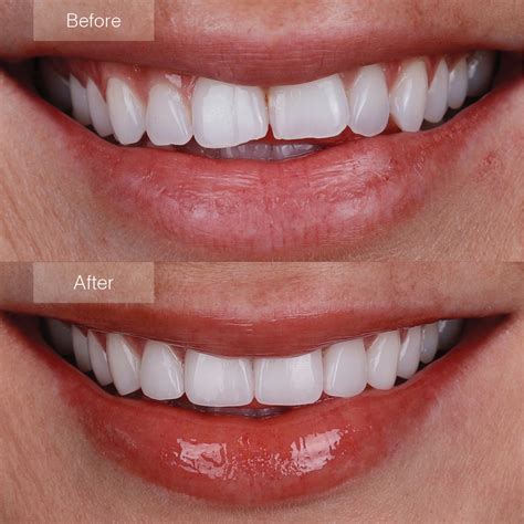 Porcelain Veneers Before and After - The Dental Room
