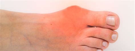Gout Treatment and Gout Attack Pain Relief -- Northwest Indiana Podiatrist