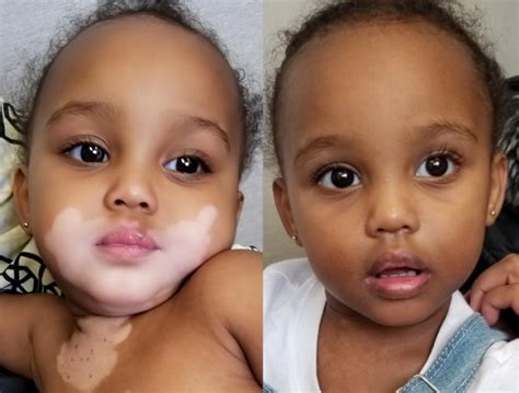 What is vitiligo, and why should I care? | Minnesota Spokesman-Recorder