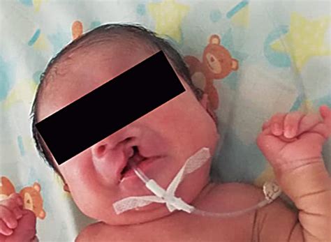 Diagnóstico y manejo perinatal del síndrome de Patau. by Sociedad ...