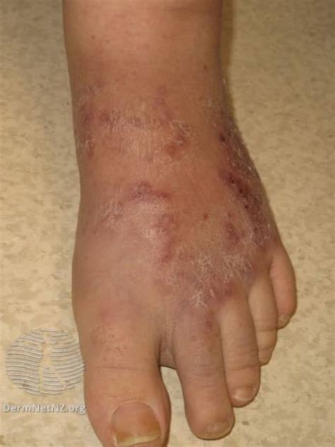 Granuloma Symptoms and Related Conditions